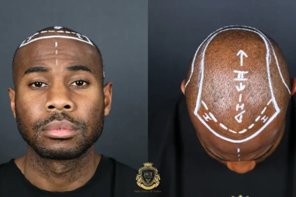 Is It Safe to Get a Hair Transplant in Turkey for Afro Hair?