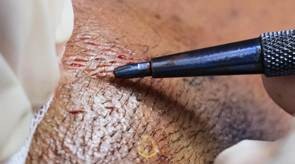 Is It Safe to Get a Hair Transplant in Turkey for Afro Hair? 3 afro hair transplant