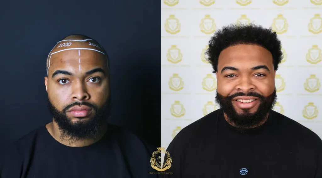 Is It Safe to Get a Hair Transplant in Turkey for Afro Hair? 2 afro hair transplant