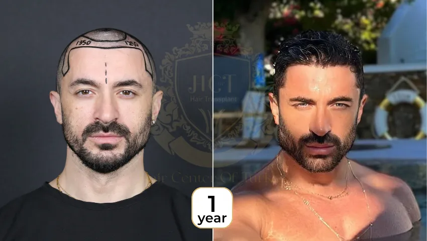 hair-transplant-before-after-pictures-1
