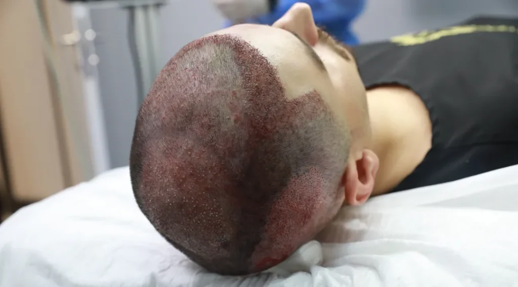 hair transplant istanbul - Quality and Expertise Across Turkey