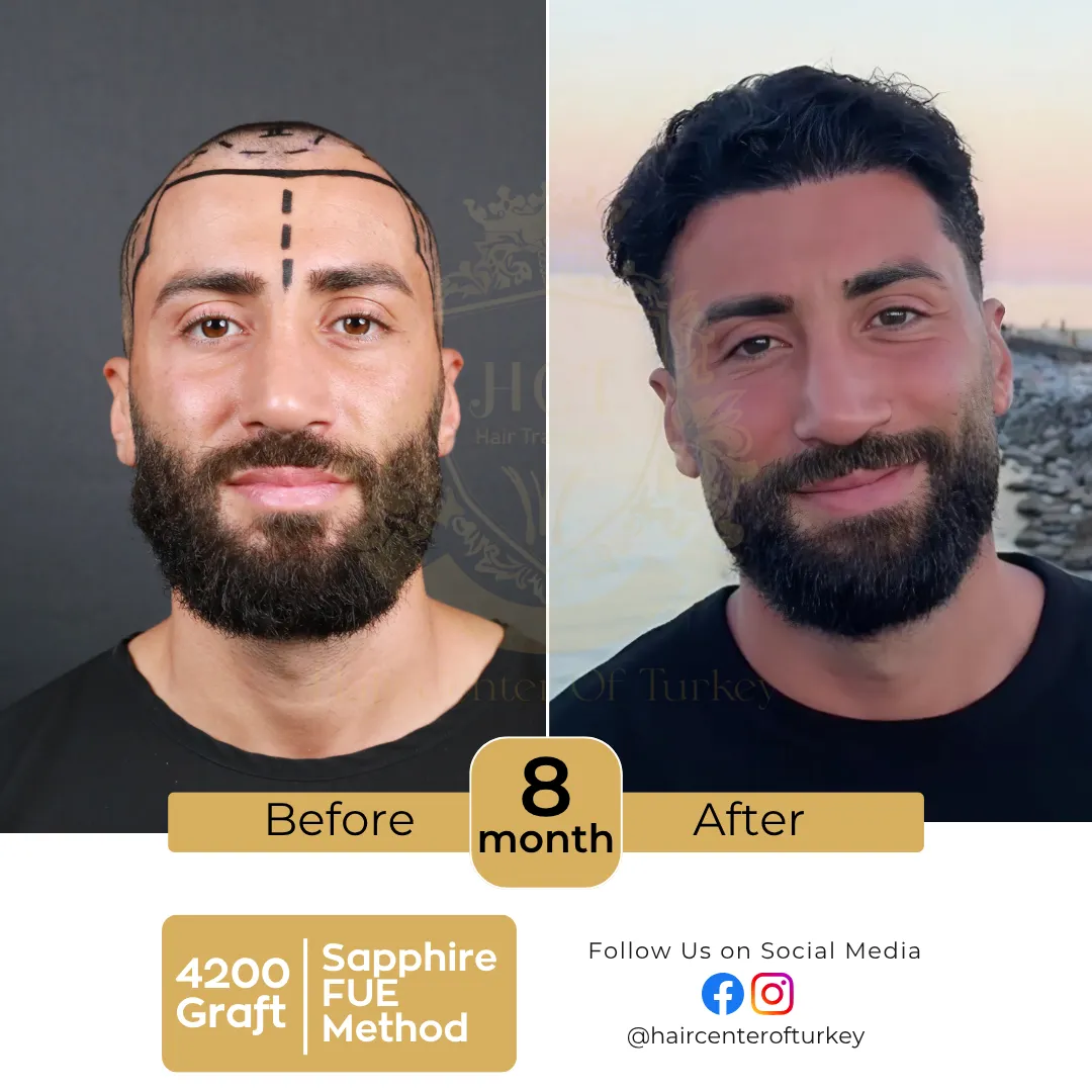 hair transplant before and after results 2026