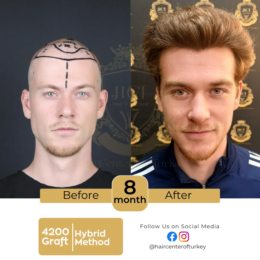 hair transplant before and after results 2026