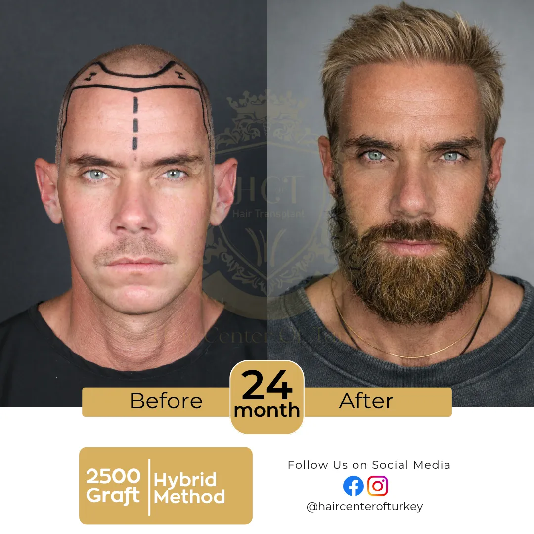 hair transplant before and after results 2026