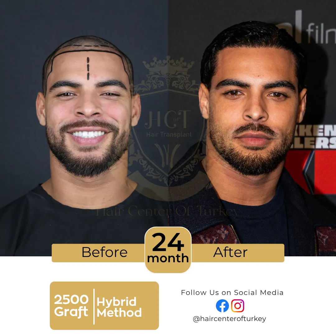 hair transplant before and after results 2026