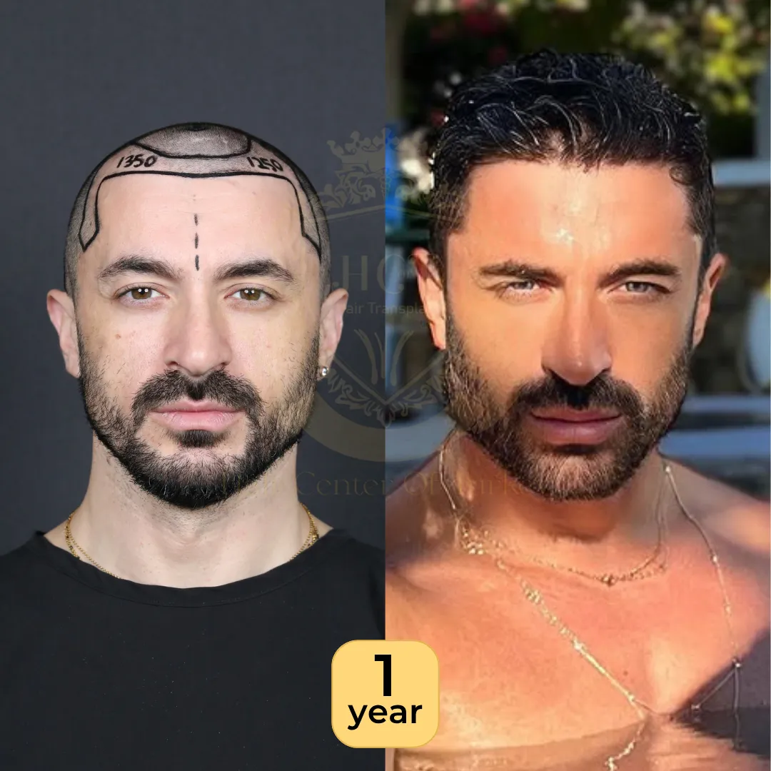 hct clinic hair transplant before and afters