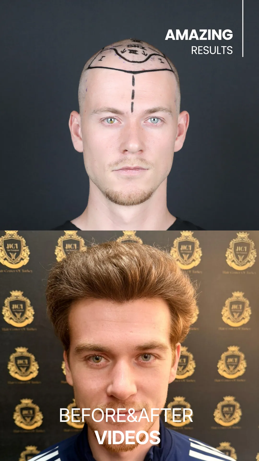robbe before and after
