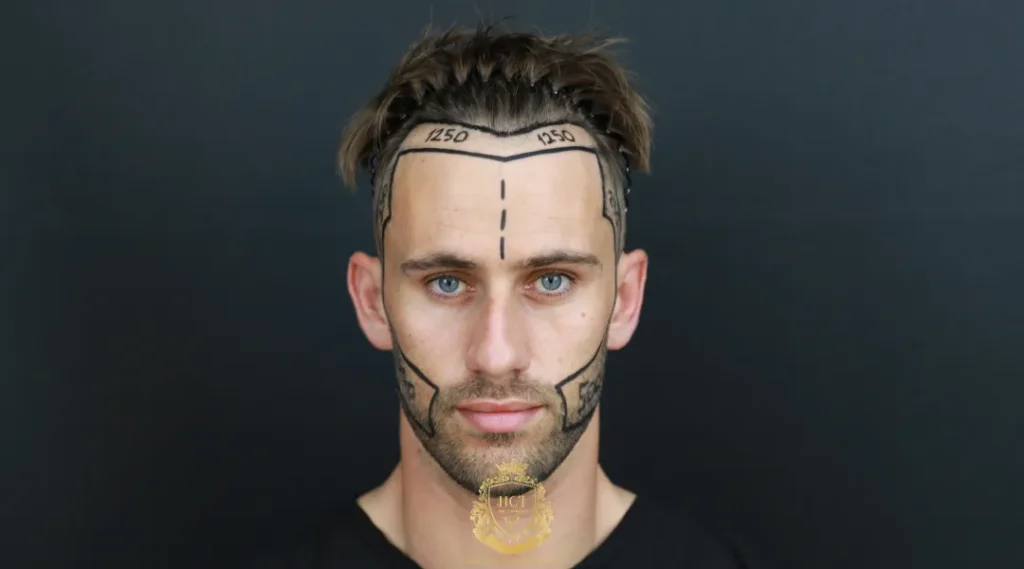 Is a Partially Shaven Hair Transplant Right for You? 2 shaven hair transplant right for you