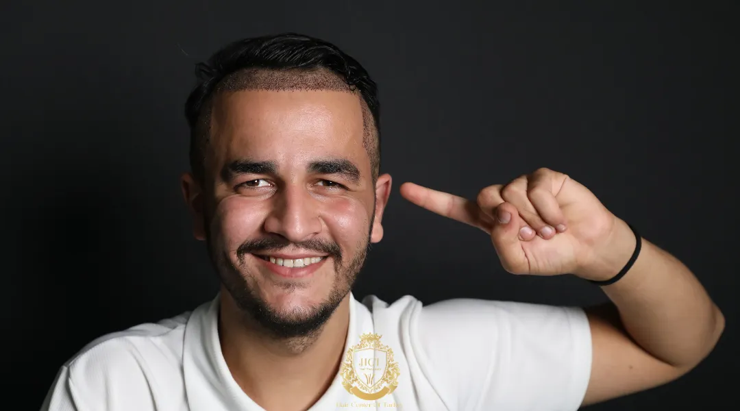 Is a Partially Shaven Hair Transplant Right for You? 1 shaven hair transplant right for you