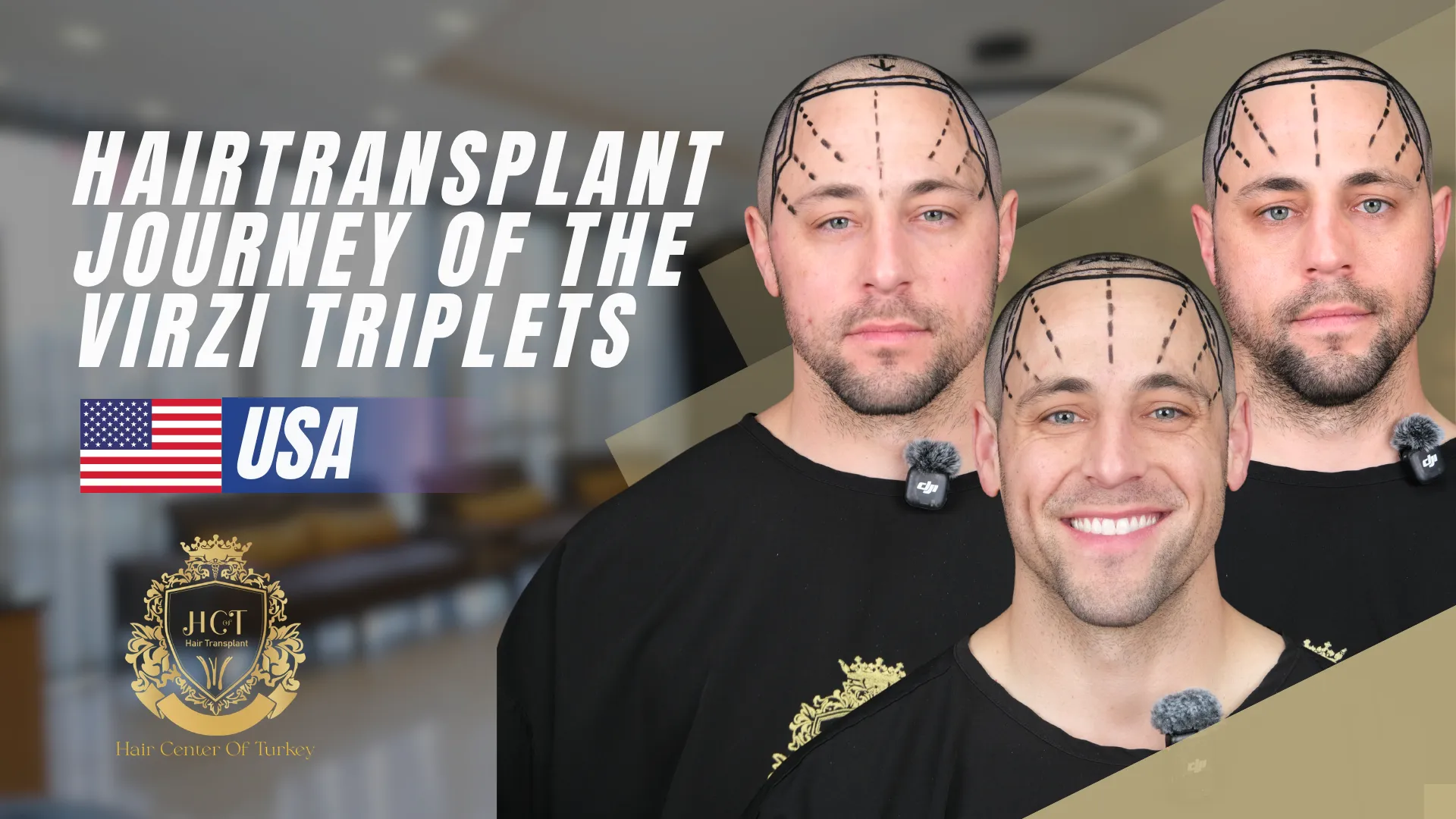 De haartransplantatiereis van de Virzi-drieling