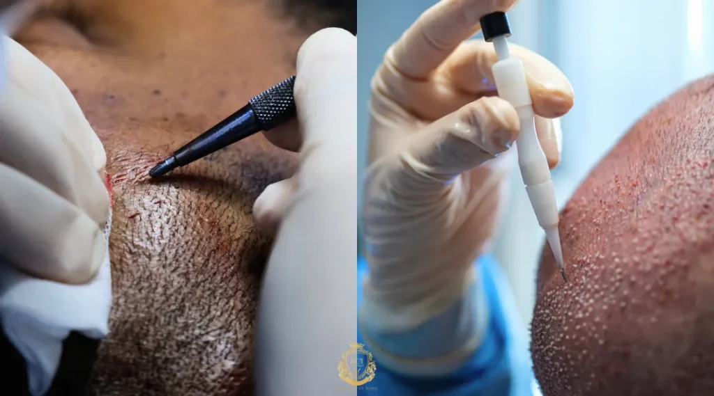 How Do Different Hair Transplant Methods Compare