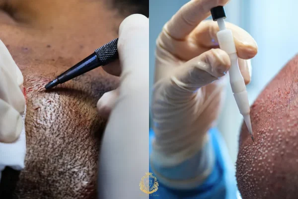 How Do Different Hair Transplant Methods Compare?