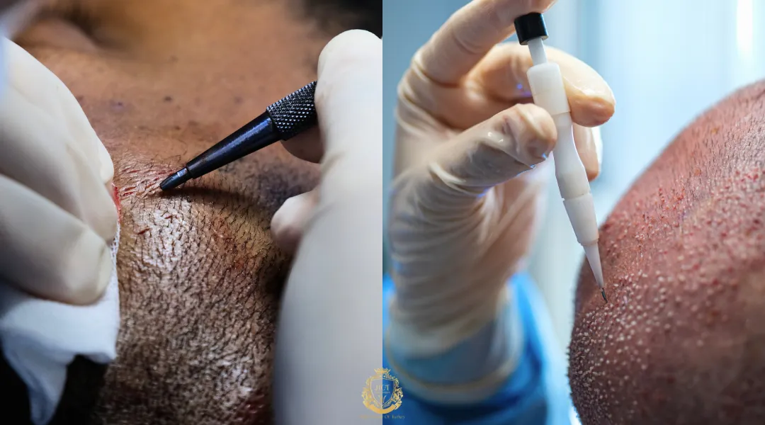 How Do Different Hair Transplant Methods Compare? 1 How Do Different Hair Transplant Methods Compare