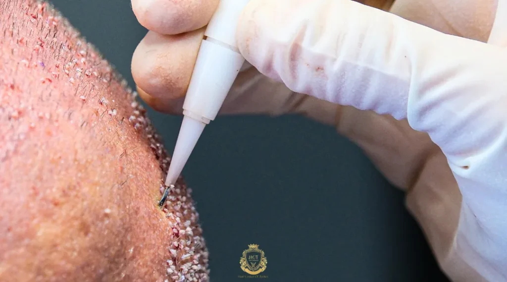 How Do Different Hair Transplant Methods Compare? 3 How Do Different Hair Transplant Methods Compare?