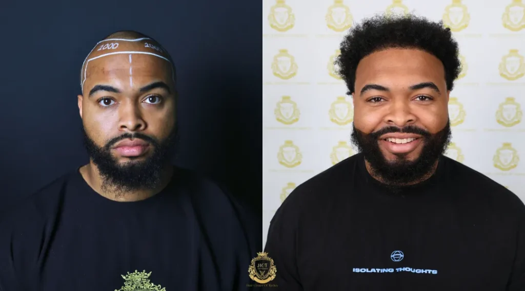 How Do Different Hair Transplant Methods Compare? 4 How Do Different Hair Transplant Methods Compare?