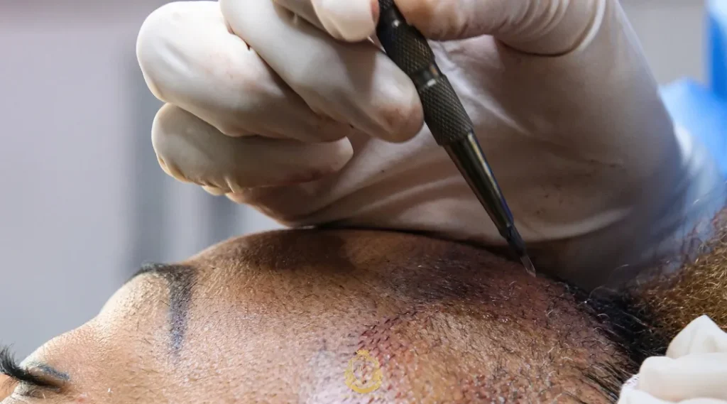 How Do Different Hair Transplant Methods Compare? 2 How Do Different Hair Transplant Methods Compare?