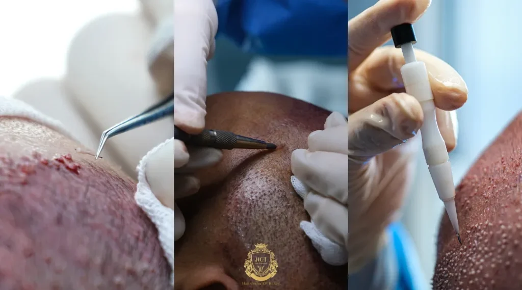 FUE Vs. DHI Vs. Sapphire FUE For Traveling Patients