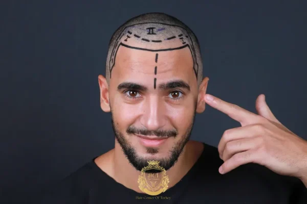 Conteggio degli innesti per trapianto di capelli: perché le stime online degli innesti possono essere diverse