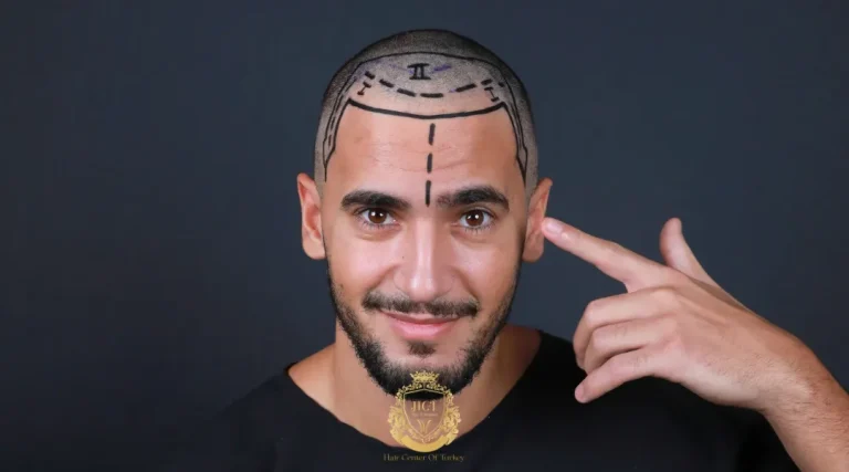 Hair Transplant Graft Counts