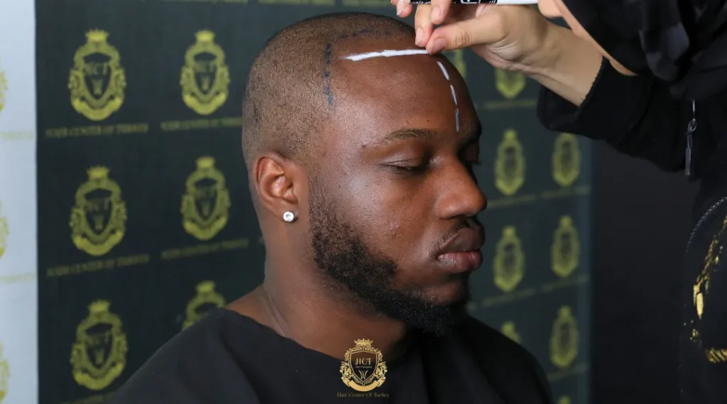 How A Hair Transplant Works The Medical Basics