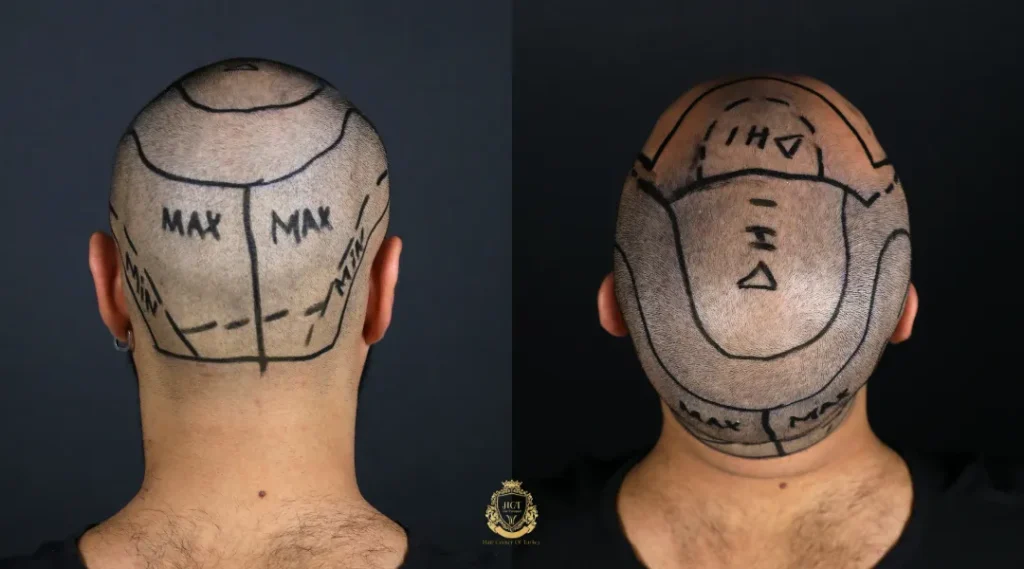 What Should I Know About Donor Area Health For Hair Transplants? 3 Pre-Transplant Donor Analysis And Candidacy