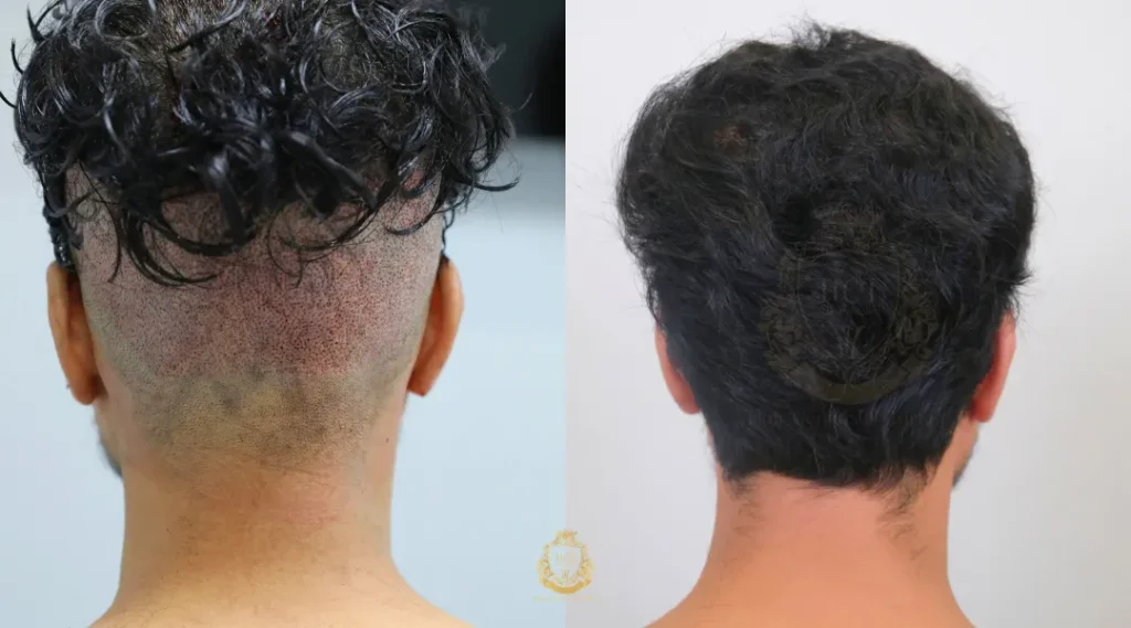 What Should I Know About Donor Area Health For Hair Transplants? 2 What Doctors Look For In A Healthy Donor Area