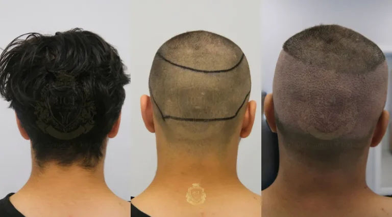 donor area hair transplant