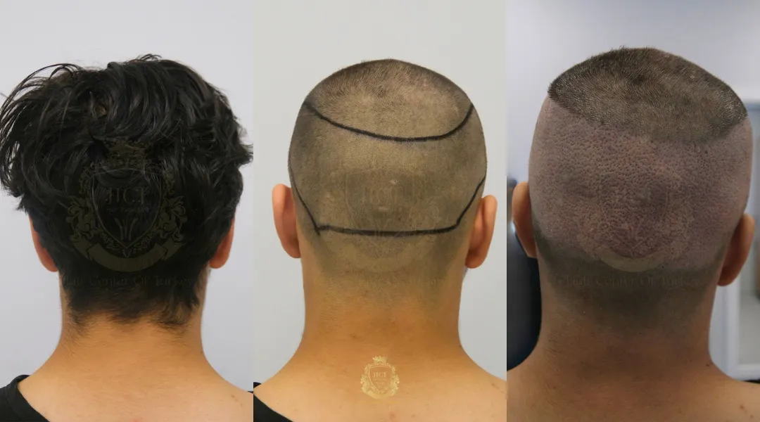 What Should I Know About Donor Area Health For Hair Transplants? 1 donor area hair transplant