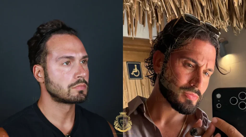hair transplant results in turkey