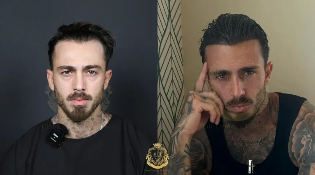 hair transplant results in turkey