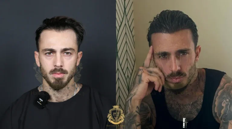 hair transplant results in turkey