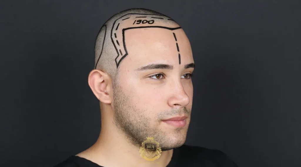 natural hairline for hair transplant in turkey